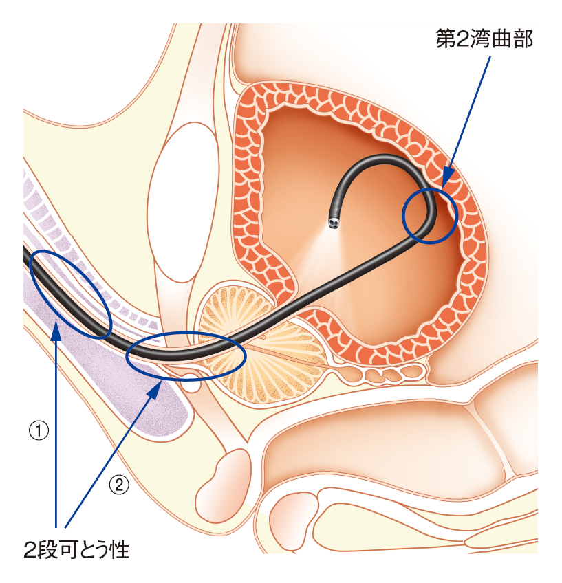 膀胱腎盂ビデオスコープ CYF-VHA|製品情報|オリンパス医療ウェブサイト メディカルタウン