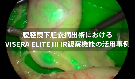 腹腔鏡下胆嚢摘出術におけるVISERA ELITE III IR観察機能の活用事例